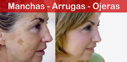 Bicarbonato De Sodio Para La Arrugas Y Manchas En El Rostro.